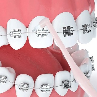 5x Interdentalbürsten Weiche Borsten Tiefenreinigung Zahnspangen Grün